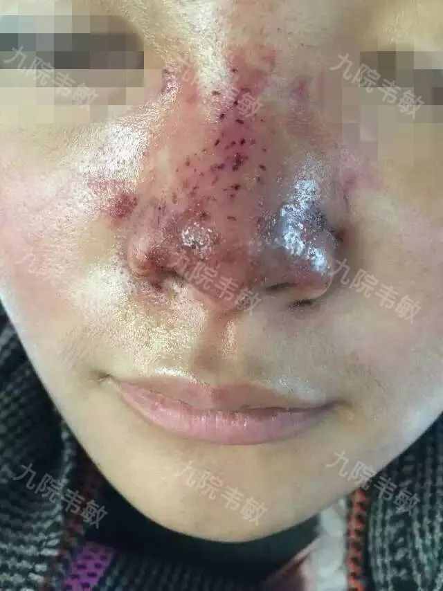 鼻整形為什么不建議注射隆鼻？