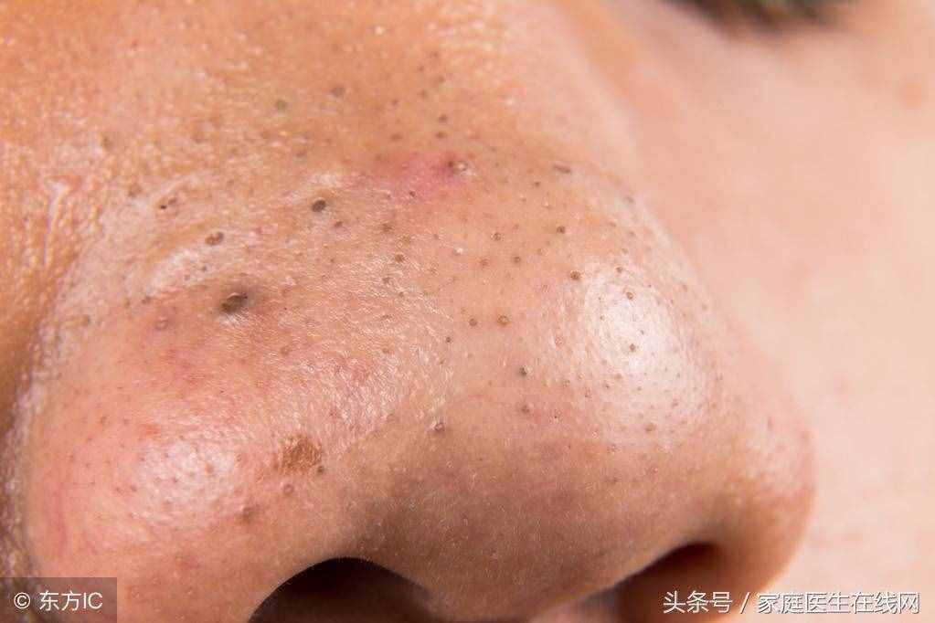 臉上黑頭太多怎么辦？這3個正確方法幫助你消滅它們