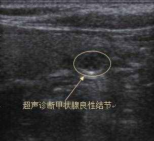 七個問答，全面了解甲狀腺結(jié)節(jié)