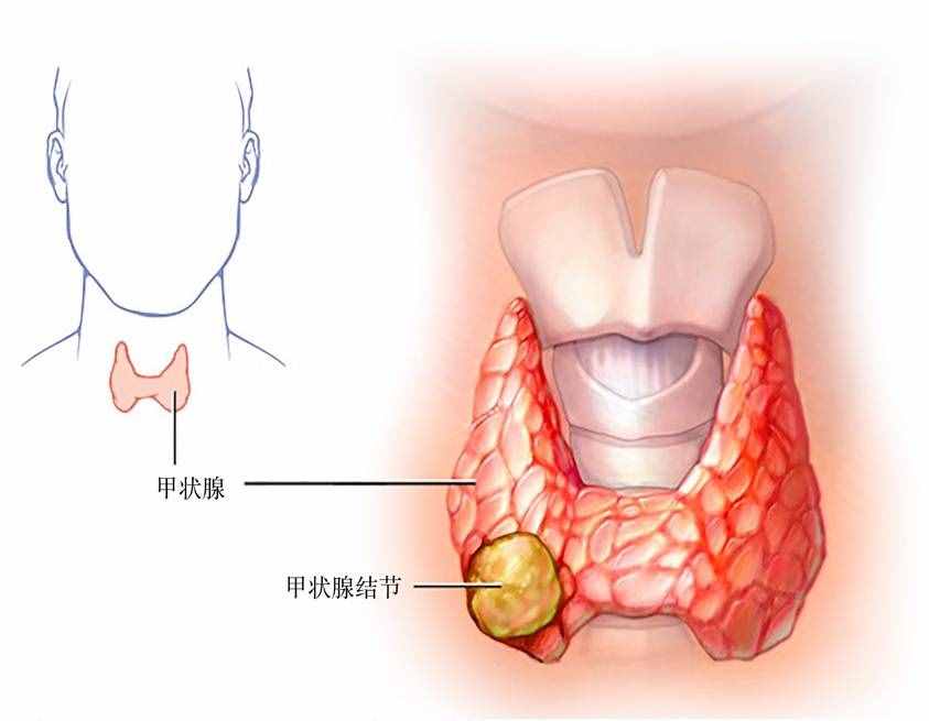 七個問答，全面了解甲狀腺結(jié)節(jié)