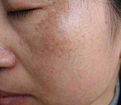 臉上有很多斑怎么淡斑？四種小妙招