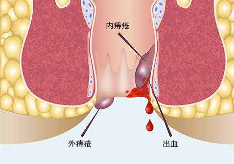 痔瘡癥狀圖片