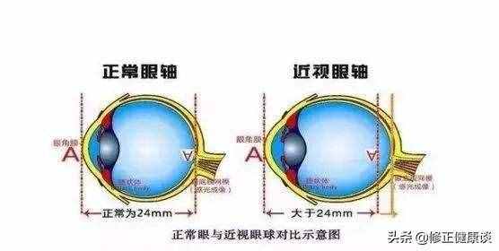 近視的人，經(jīng)常戴眼鏡讓眼睛變形了，怎么辦