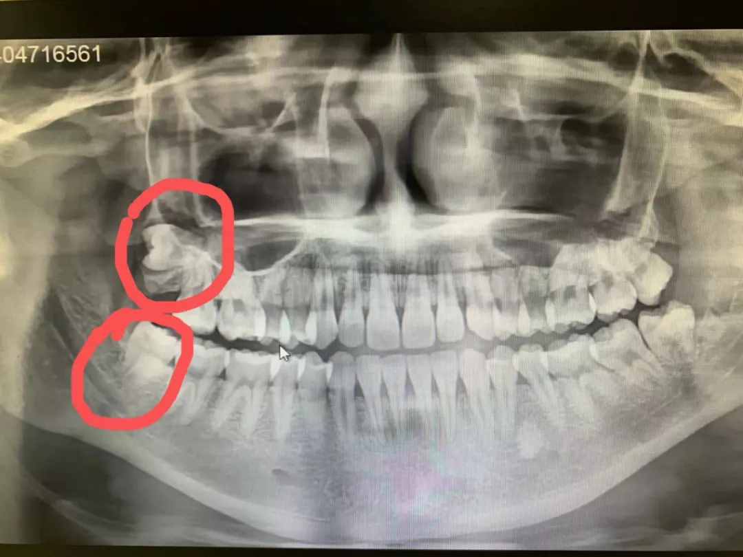 牙醫(yī)的溫柔之微創(chuàng)拔牙，用專業(yè)細(xì)致“搞定”疑難阻生牙（上）