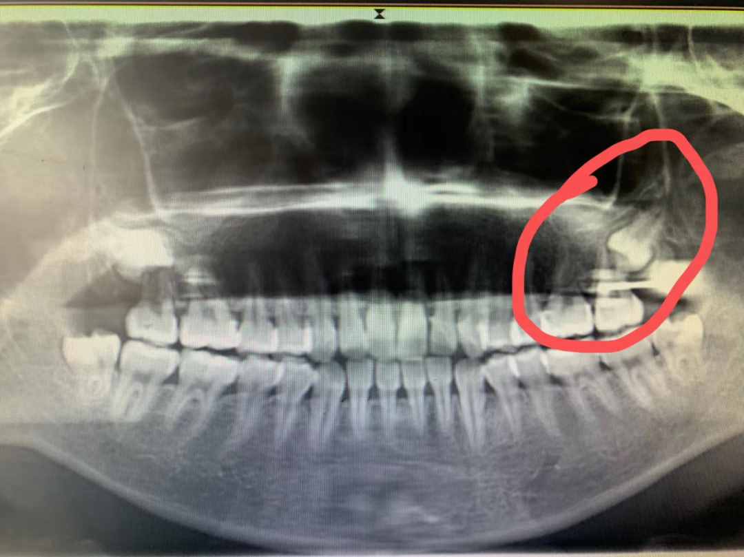 牙醫(yī)的溫柔之微創(chuàng)拔牙，用專業(yè)細(xì)致“搞定”疑難阻生牙（上）