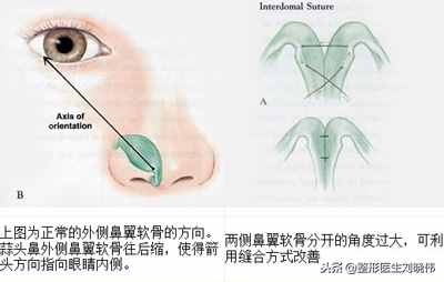 有什么好辦法能讓大鼻頭變??？