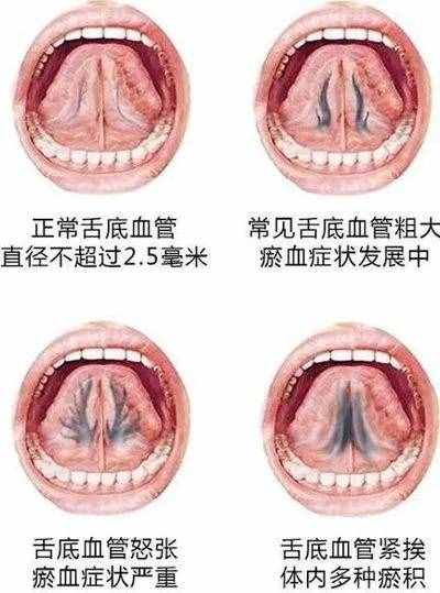 神奇的中醫(yī)放血療法