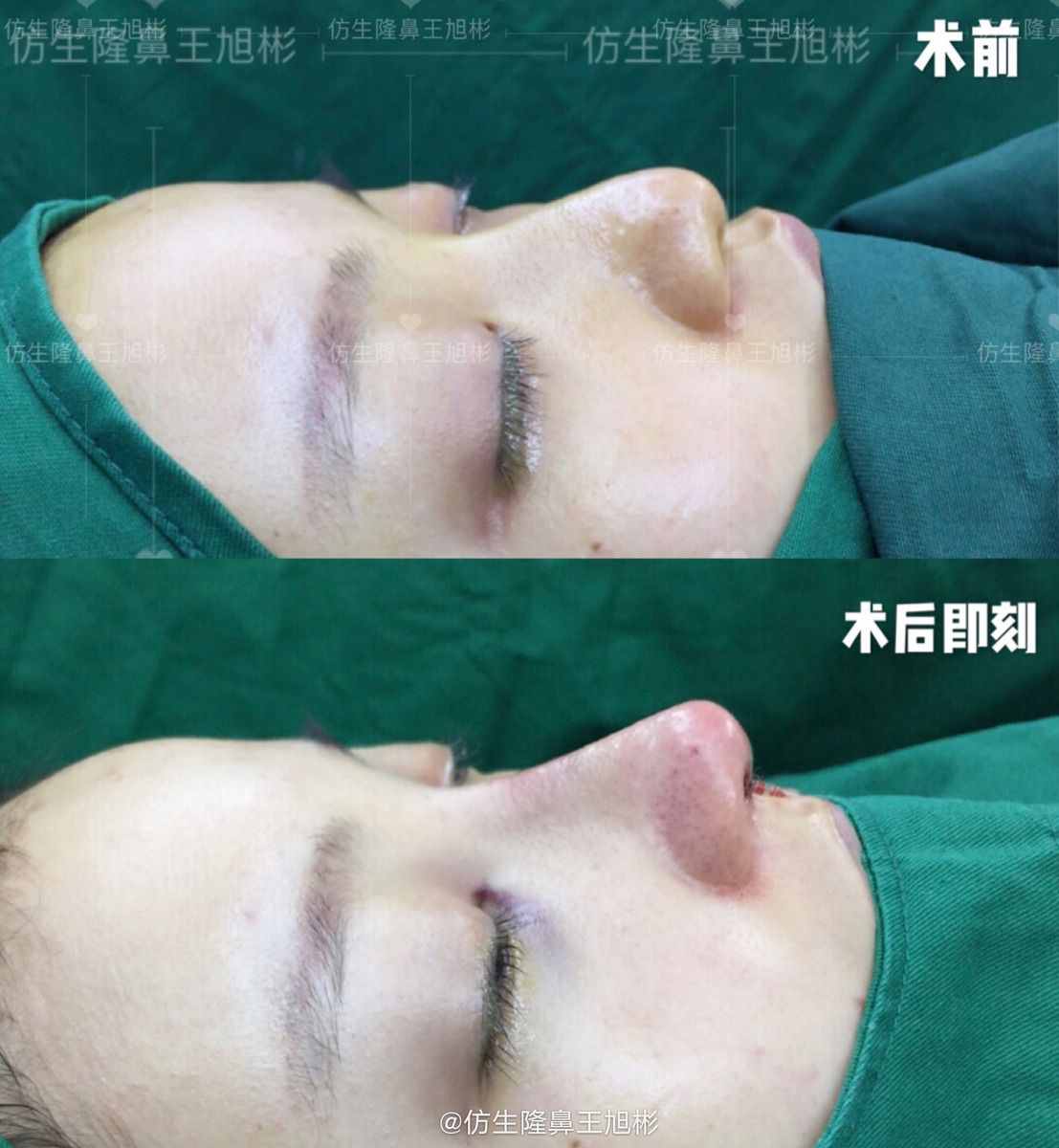 鼻頭肥塌大，如何逆襲成自然小秀挺？王旭彬仿生鼻尖整形案例