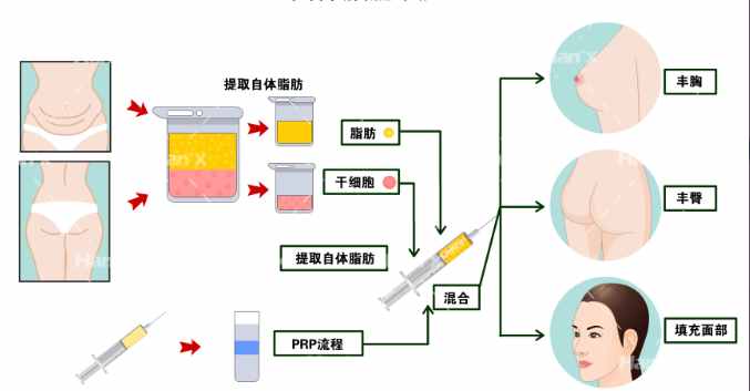 芒果吸脂手術(shù)的安全性怎么樣？