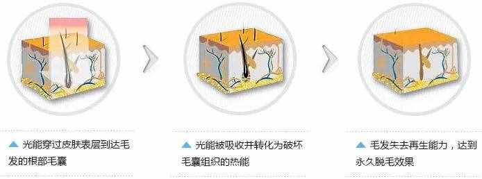 10分鐘永久全身脫毛，給你一個滑溜溜的夏天