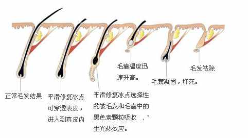 冰點脫毛原理圖解