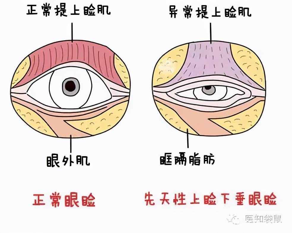 為什么從小就有抬頭紋，眼睛還比別人小？