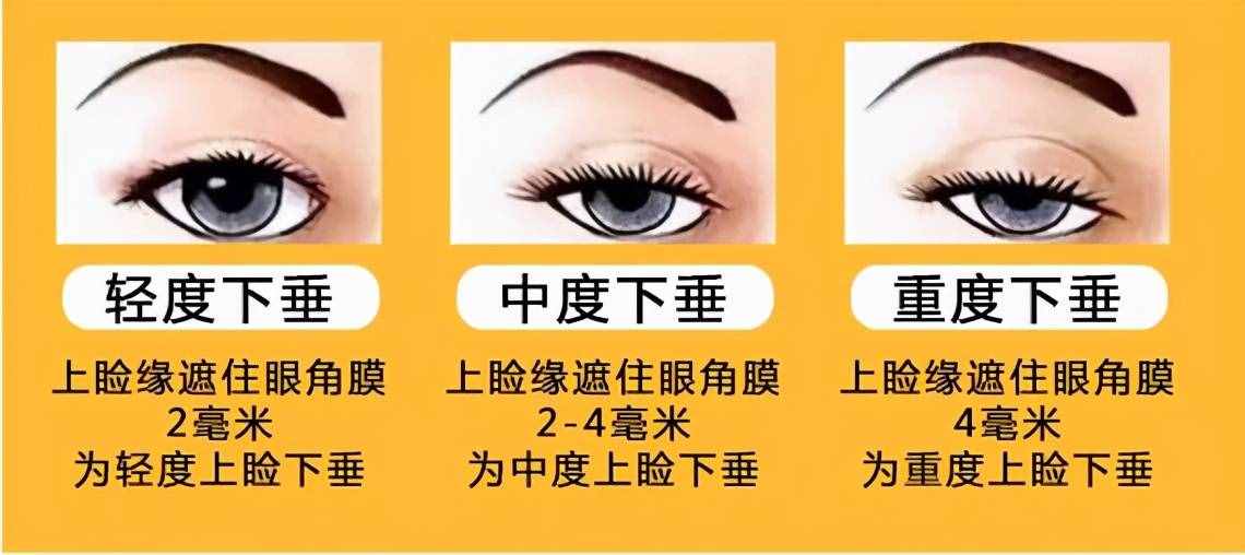 為什么從小就有抬頭紋，眼睛還比別人??？