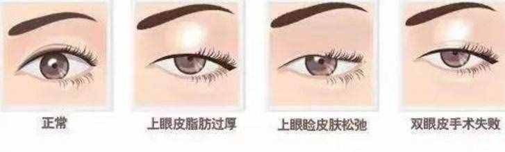 為什么從小就有抬頭紋，眼睛還比別人??？