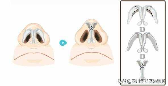 鼻翼縮小術(shù)三種常見(jiàn)方法