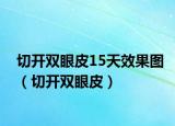 切開雙眼皮15天效果圖（切開雙眼皮）