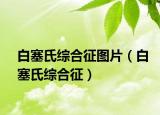 白塞氏綜合征圖片（白塞氏綜合征）