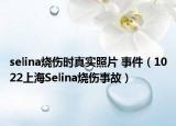 selina燒傷時真實照片 事件（1022上海Selina燒傷事故）