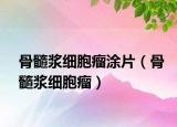 骨髓漿細(xì)胞瘤涂片（骨髓漿細(xì)胞瘤）