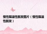 慢性脂溢性脫發(fā)圖片（慢性脂溢性脫發(fā)）