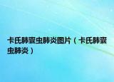 卡氏肺囊蟲肺炎圖片（卡氏肺囊蟲肺炎）