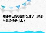 頸部淋巴結(jié)核是什么樣子（頸部淋巴結(jié)核是什么）