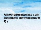 灰指甲的初期癥狀怎么解決（灰指甲的初期癥狀 輕微灰指甲的癥狀圖片）