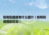 粉刺和痘痘有什么圖片（粉刺和痘痘的區(qū)別）