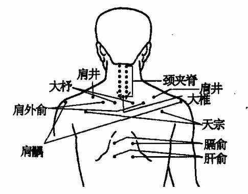 拔火罐能治療頸椎病，為家人收藏起來！