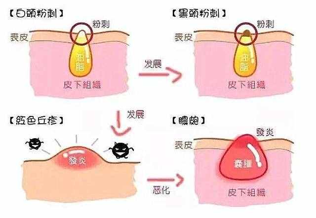 什么是閉口粉刺？為什么會長閉口？如何有效去閉口