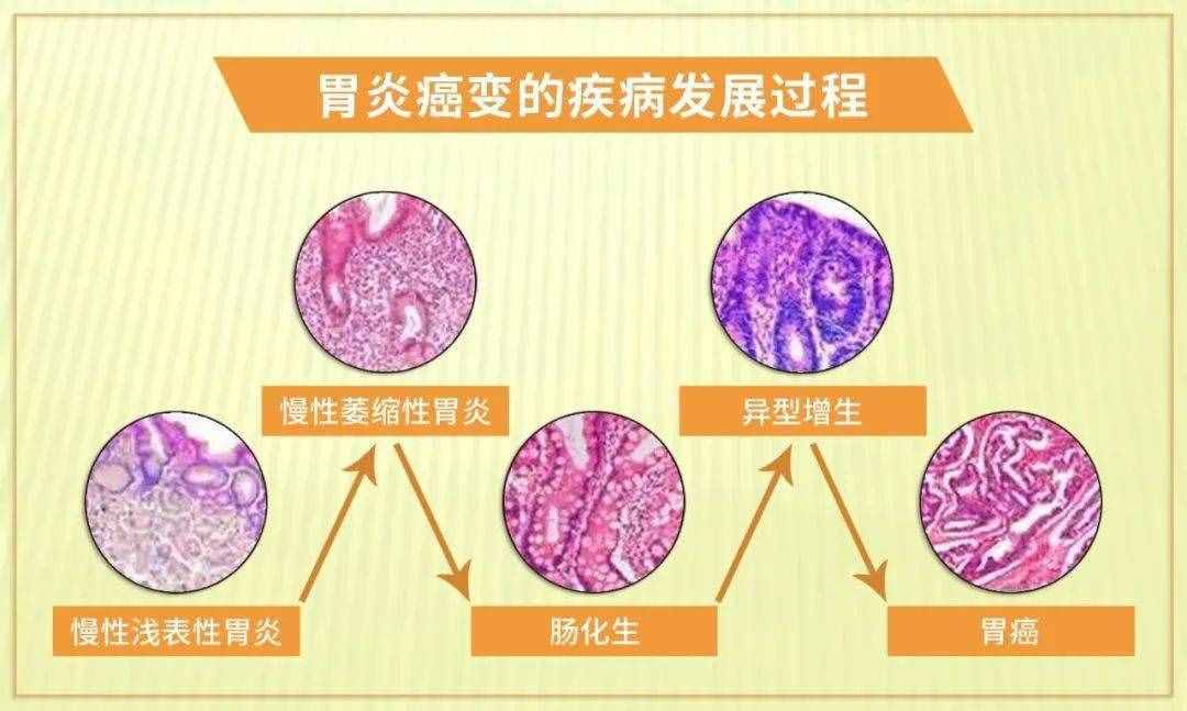 胃病都有哪些，什么癥狀