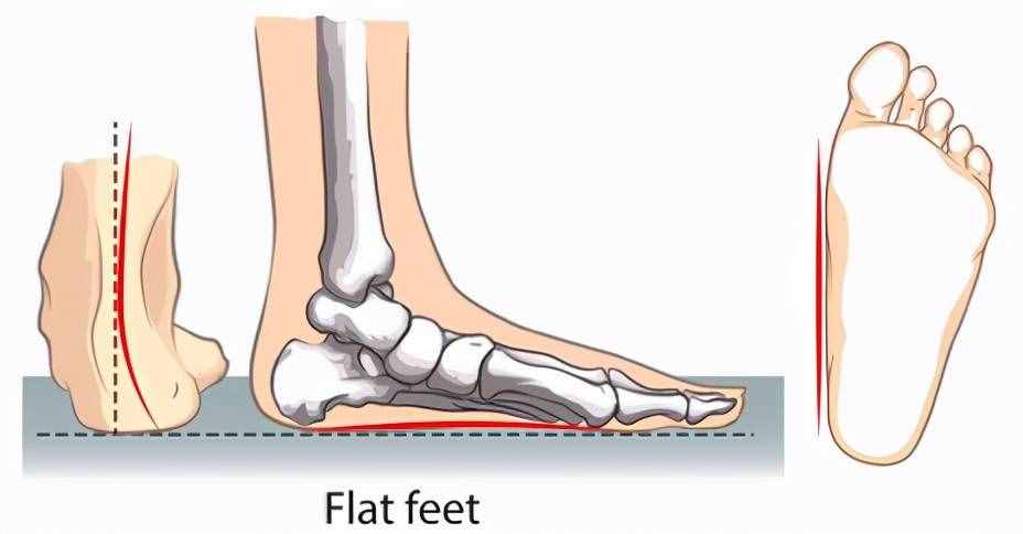 扁平足——有一種痛叫做“腳踏實地”的痛
