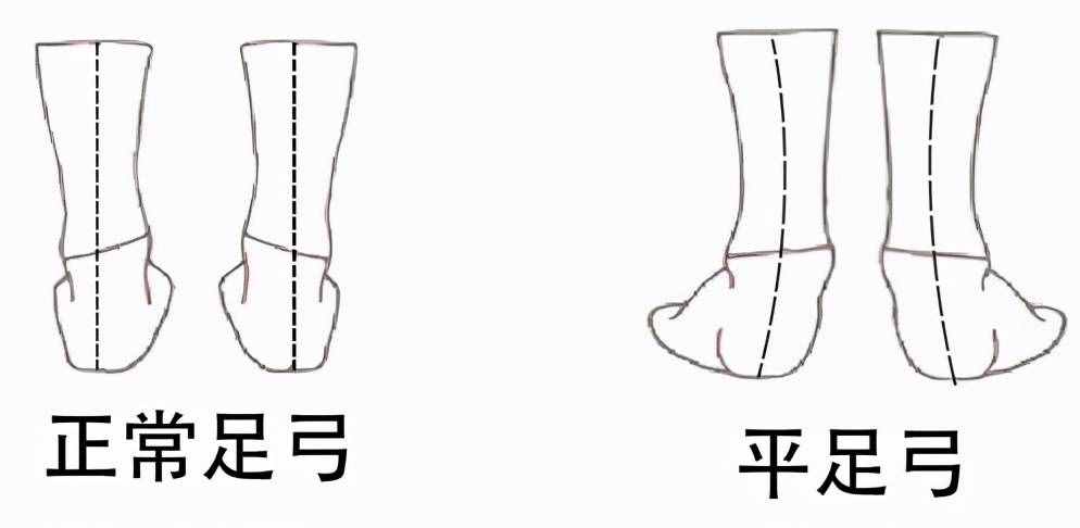 扁平足——有一種痛叫做“腳踏實地”的痛