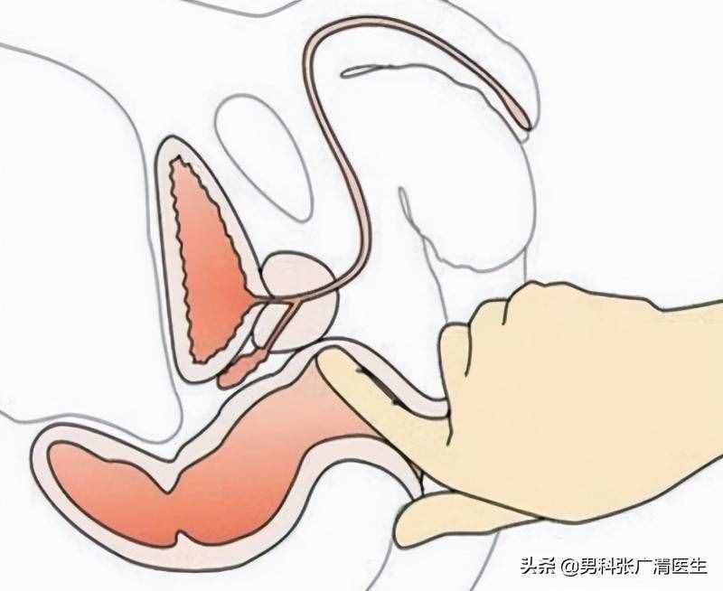 前列腺的“爆菊花”指檢法