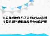 當(dāng)日最新消息 男子瞞著燒傷父親割皮救父 煤氣罐爆炸致父親燒傷嚴(yán)重