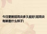 今日更新冠周炎多久能好(冠周炎有膿是什么樣子)