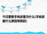 今日更新手蛻皮是為什么(手蛻皮是什么原因?qū)е碌?