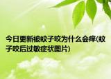 今日更新被蚊子咬為什么會(huì)癢(蚊子咬后過(guò)敏癥狀圖片)