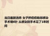 當日最新消息 女子擠痘痘臉部感染手術(shù)縫6針 從感染到手術(shù)花了1年時間
