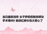 當(dāng)日最新消息 女子擠痘痘臉部感染手術(shù)縫6針 臉部紅腫長(zhǎng)包太惡心了