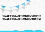 林志穎手臂放入鈦合金板固定詳細(xì)內(nèi)容 林志穎手臂放入鈦合金板固定具體介紹