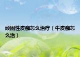 頑固性皮癬怎么治療（牛皮癬怎么治）