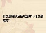 什么是皰疹及癥狀圖片（什么是皰疹）
