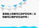 寶寶臉上奶癬可以涂爐甘石嗎（長奶癬可以用爐甘石治療嗎）