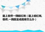 腿上發(fā)癢一撓起紅斑（腿上暗紅斑,極癢,一撓就變成疙瘩怎么辦）