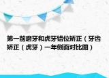 第一前磨牙和虎牙錯(cuò)位矯正（牙齒矯正（虎牙）一年側(cè)面對(duì)比圖）
