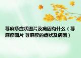 蕁麻疹癥狀圖片及病因有什么（蕁麻疹圖片 蕁麻疹的癥狀及病因）