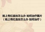 臉上有紅血絲怎么辦 如何治療圖片（臉上有紅血絲怎么辦 如何治療）