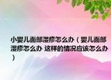 小嬰兒面部濕疹怎么辦（嬰兒面部濕疹怎么辦 這樣的情況應(yīng)該怎么辦）