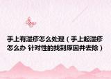 手上有濕疹怎么處理（手上起濕疹怎么辦 針對性的找到原因并去除）